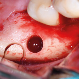 Transfer-Control - набор для горизонтального и вертикального наращивания костной ткани с помощью костных трансплантатов № 3 Transfer-Control - набор для горизонтального и вертикального наращивания костной ткани с помощью костных трансплантатов № 3
