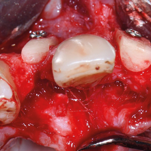 Transfer-Control - набор для горизонтального и вертикального наращивания костной ткани с помощью костных трансплантатов № 2 Transfer-Control - набор для горизонтального и вертикального наращивания костной ткани с помощью костных трансплантатов № 2