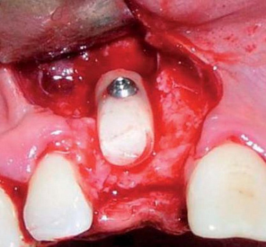 Transfer-Control - набор для горизонтального и вертикального наращивания костной ткани с помощью костных трансплантатов № 1 Transfer-Control - набор для горизонтального и вертикального наращивания костной ткани с помощью костных трансплантатов № 1